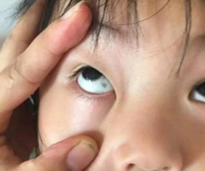 Phát hiện đốm đen trong tròng mắt con gia đình hoang mang nhanh chóng cho bé nhập viện và cái kết không ngờ - 1