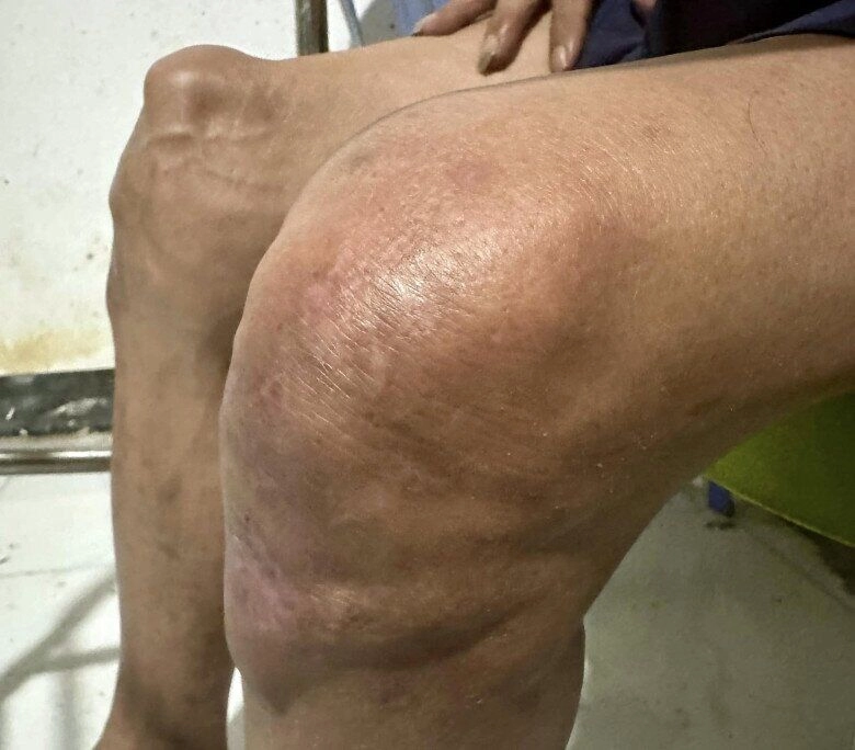 Sao việt gặp nạn để lại thương tật đàm vĩnh hưng mất nhiều ngón chân có người phải cắt 1 tay - 10