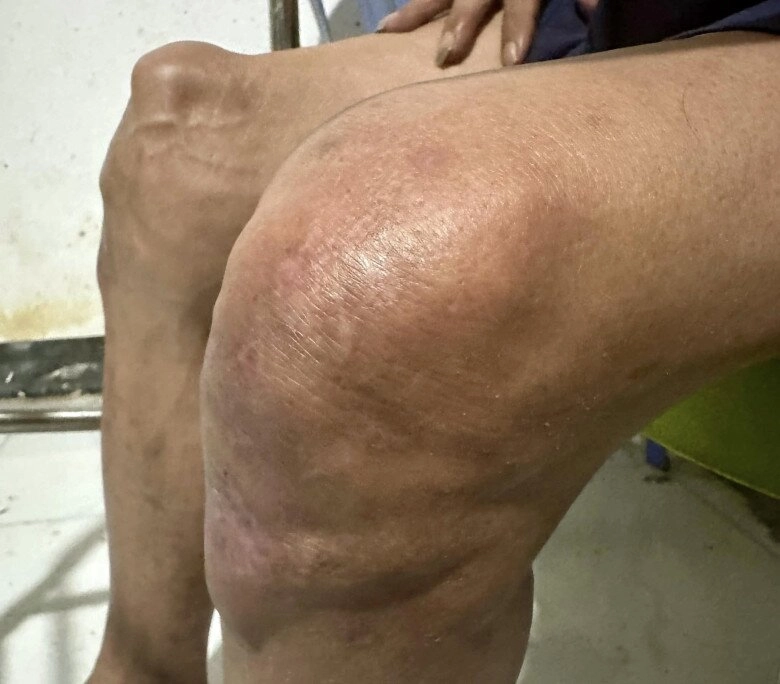 Thông tin mới nhất về tình hình sức khỏe của thương tín 1 chân không thể hồi phục chưa thể phẫu thuật vì rất yếu - 2
