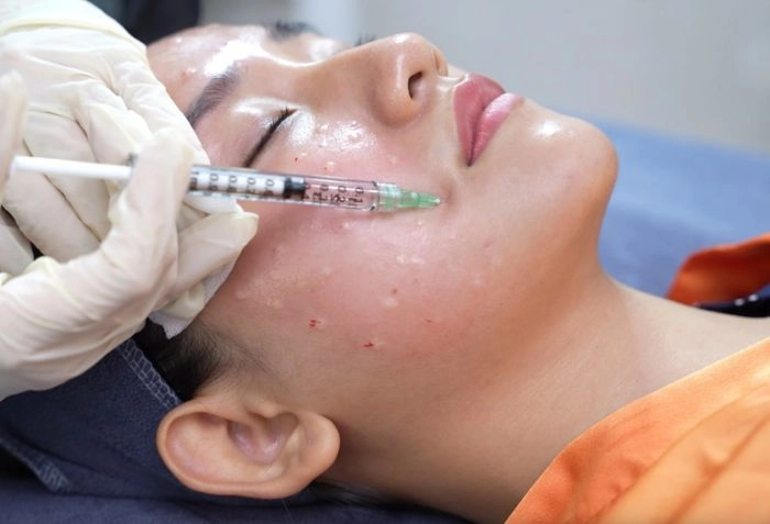 Tiêm botox khác gì với tiêm meso so sánh để lựa chọn giải pháp làm đẹp phù hợp - 2