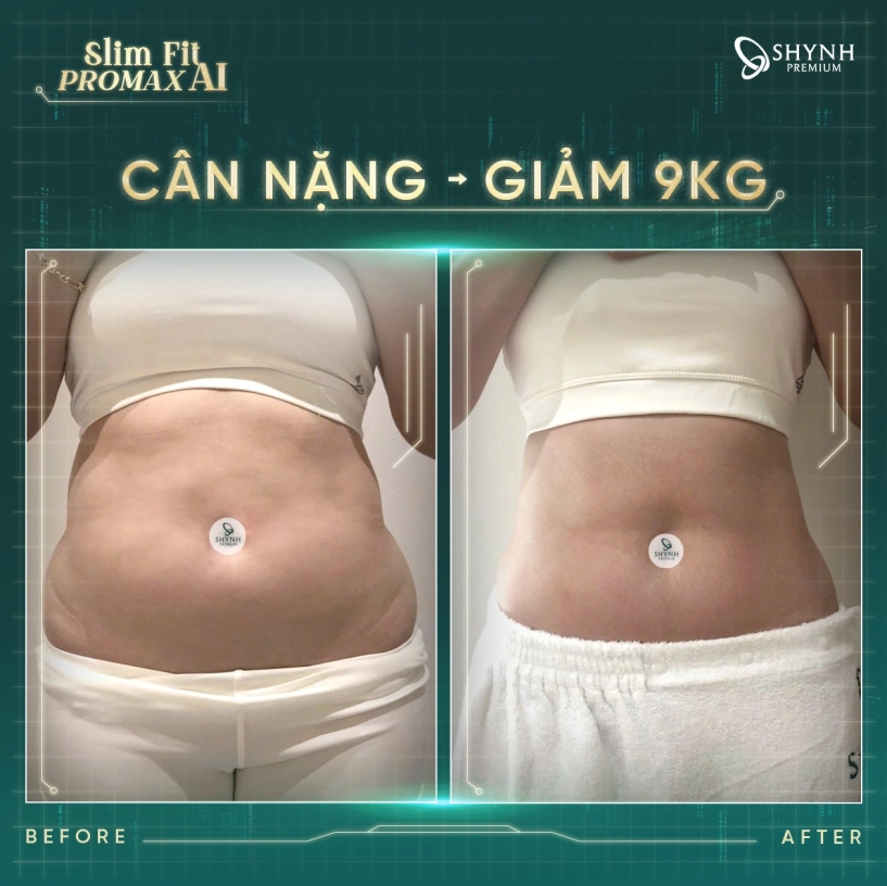 Giảm mỡ không xâm lấn giải pháp làm đẹp hiện đại tại shynh premium - 2