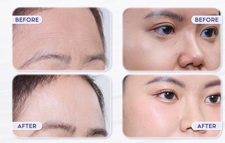 Thẩm mỹ linh anh premium ra mắt revoke50 - giải pháp skinbooster thế hệ mới giúp tái tạo và trẻ hóa da toàn diện - 4