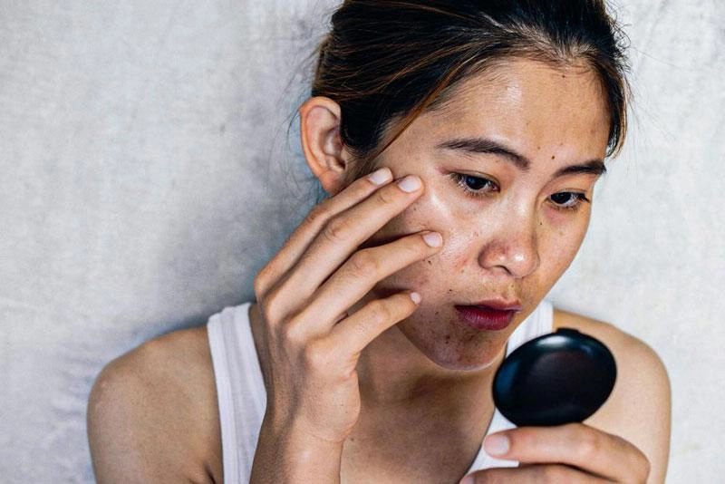 Trải nghiệm soi da ai bí quyết phát hiện nám sớm tại thẩm mỹ viện ngọc dung - 1