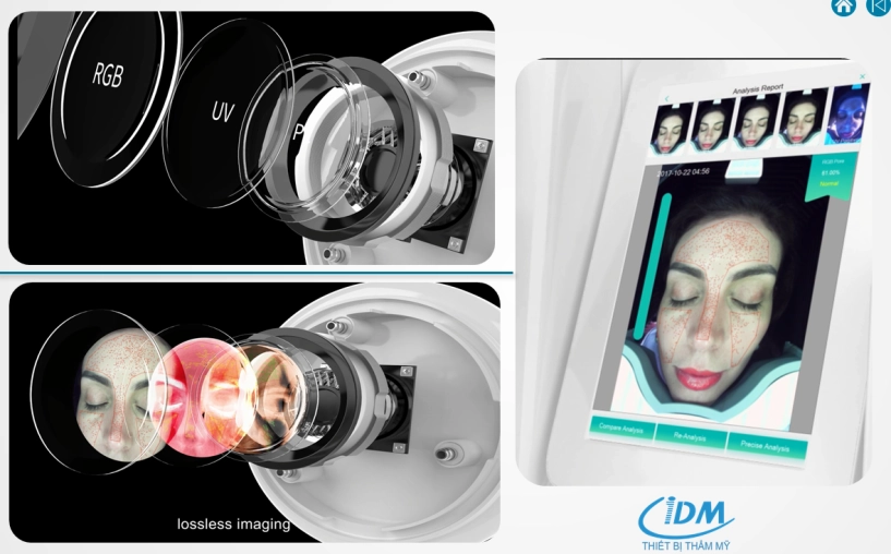 Trải nghiệm soi da ai bí quyết phát hiện nám sớm tại thẩm mỹ viện ngọc dung - 2