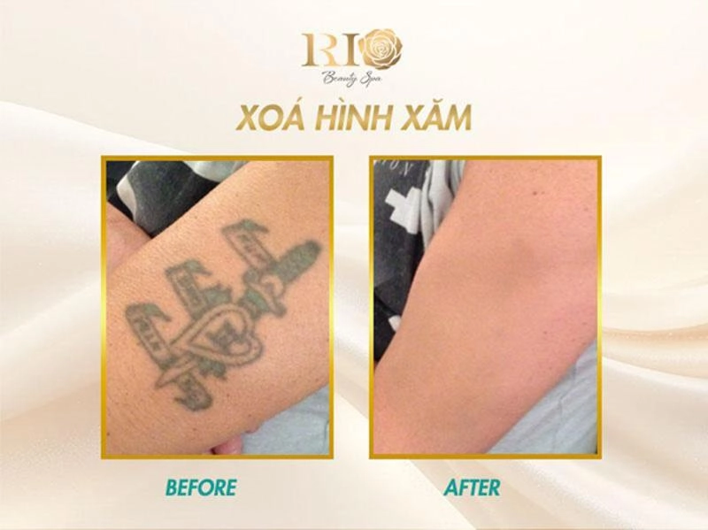 Xóa hình xăm không để lại sẹo và bí mật đằng sau - 1