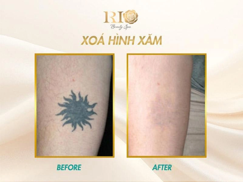 Xóa hình xăm không để lại sẹo và bí mật đằng sau - 3