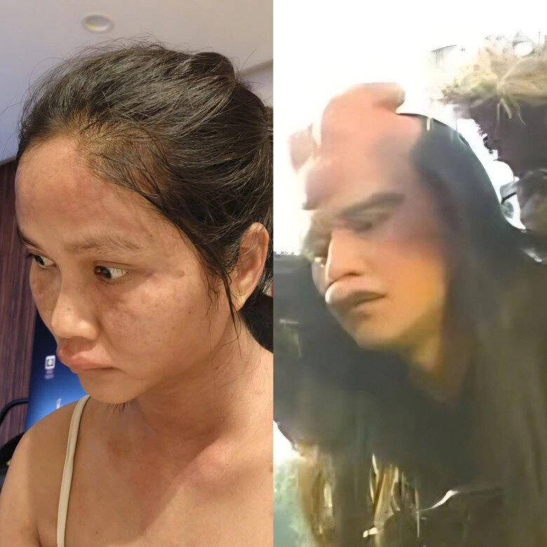 Chi nửa tỷtháng để ở cữ hhen niê nay biến dạng ngoại hình vì bệnh lạ sau sinh chỉ 110 người gặp phải - 3