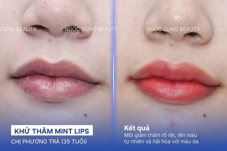Khử thâm môi mint lips có thật sự làm sáng môi chỉ sau 1 buổi không - 6
