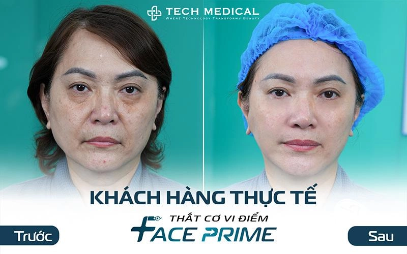 Thắt cơ vi điểm giải pháp trẻ hóa được nhiều chị em việt kiều lựa chọn - 2
